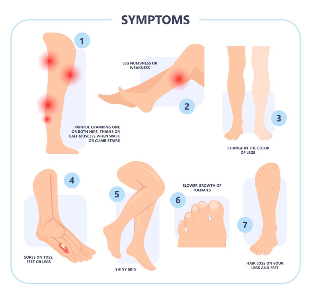 Peripheral Artery Disease (PAD) - Symptoms, Causes, & Treatment