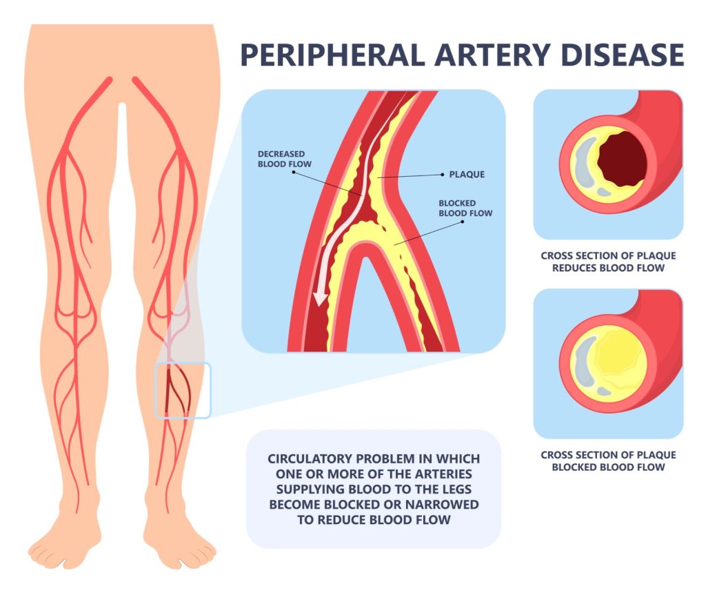 Peripheral Artery Disease (PAD) - Symptoms, Causes, & Treatment