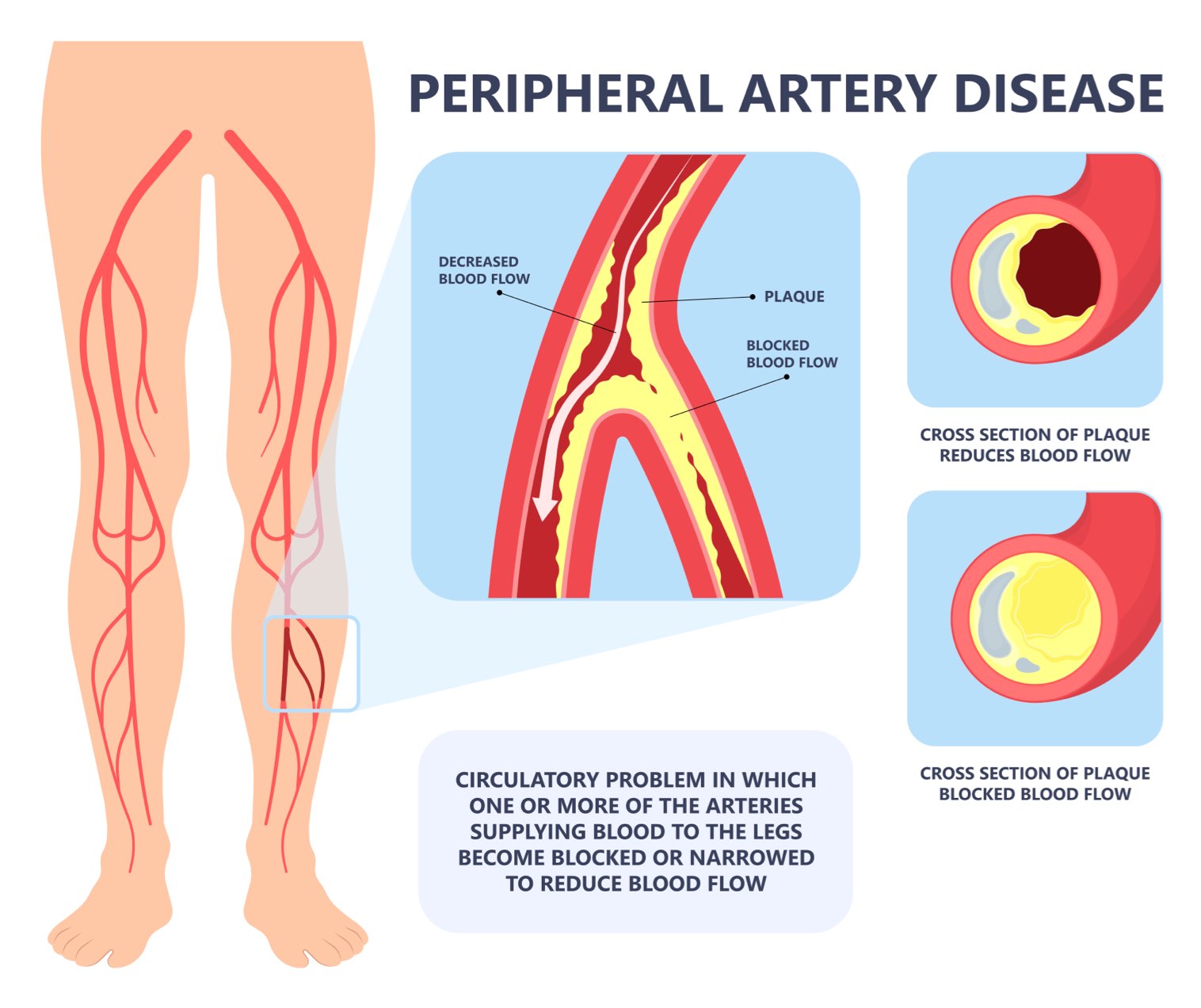 what-is-peripheral-arterial-disease-rocky-mountain-foot-ankle