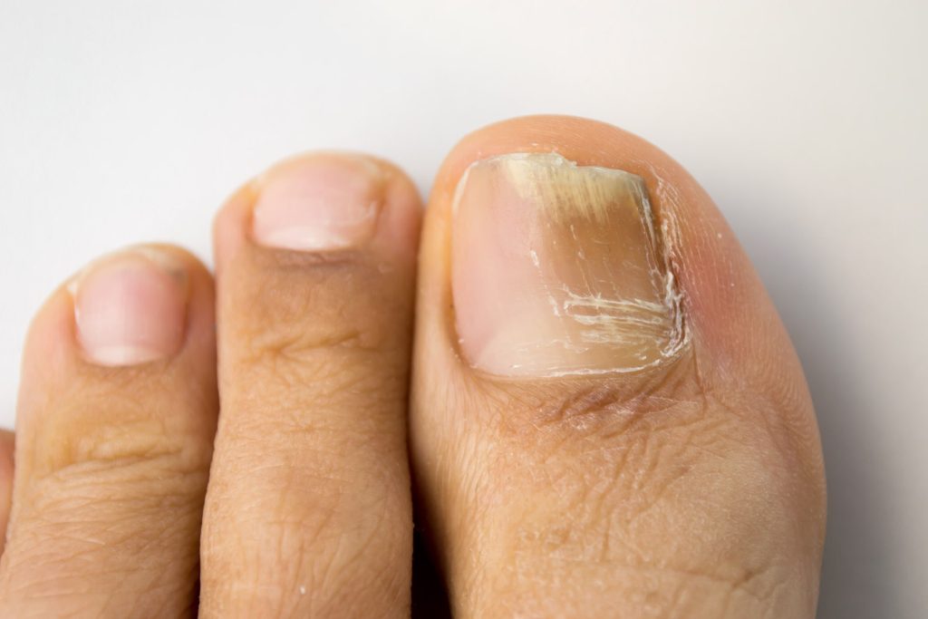 Types & Stages of Toenail Fungus