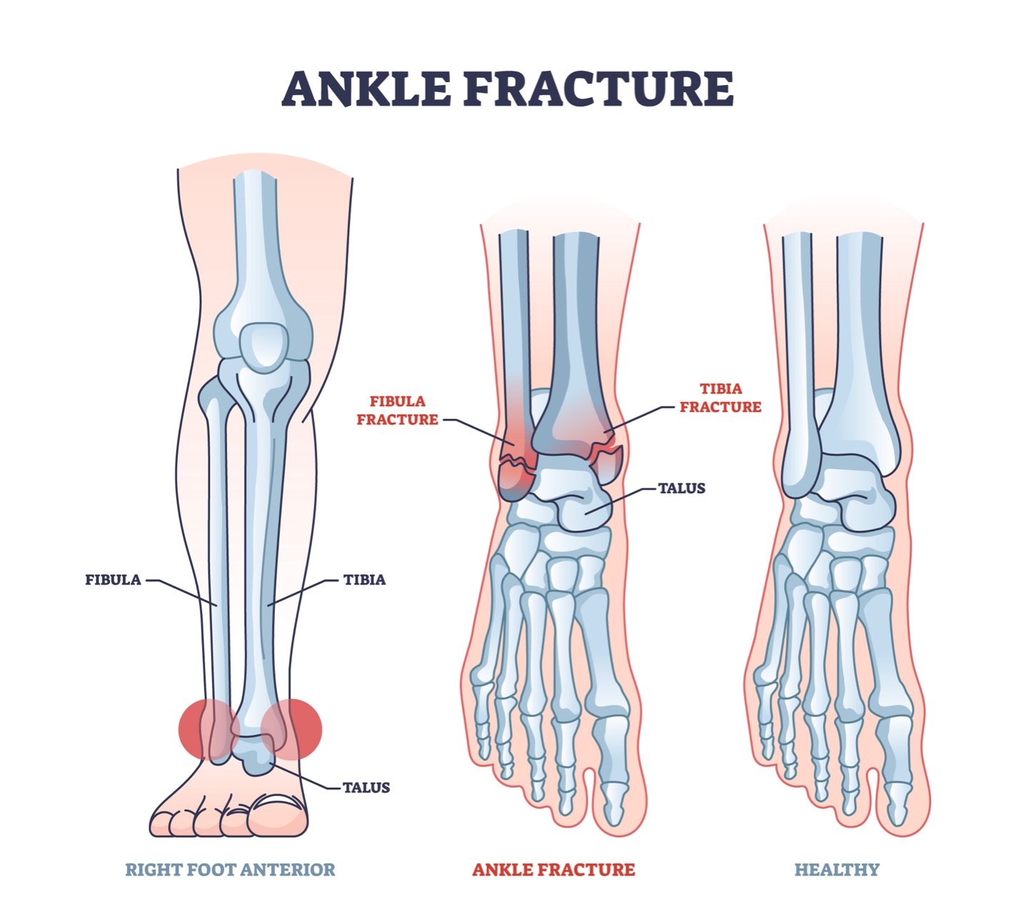 Sprained Ankle Vs Broken Ankle Rocky Mountain Foot Ankle