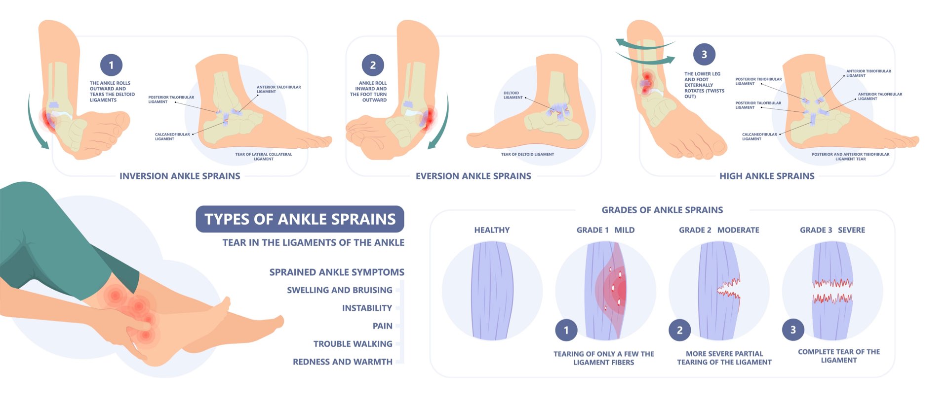 Sprained Ankle vs Broken Ankle