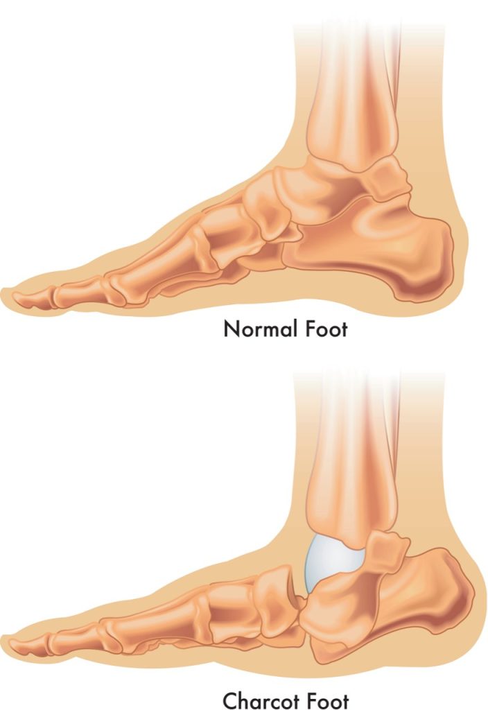 Diabetic Peripheral Neuropathy - Highlands Foot and Ankle