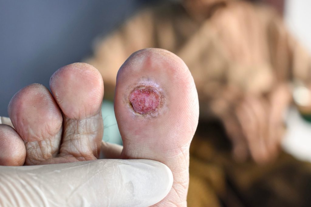 Fungal Nail infections: Was it your shoes or the clippers at the salon? How  to care for your nails | Health Tips and News