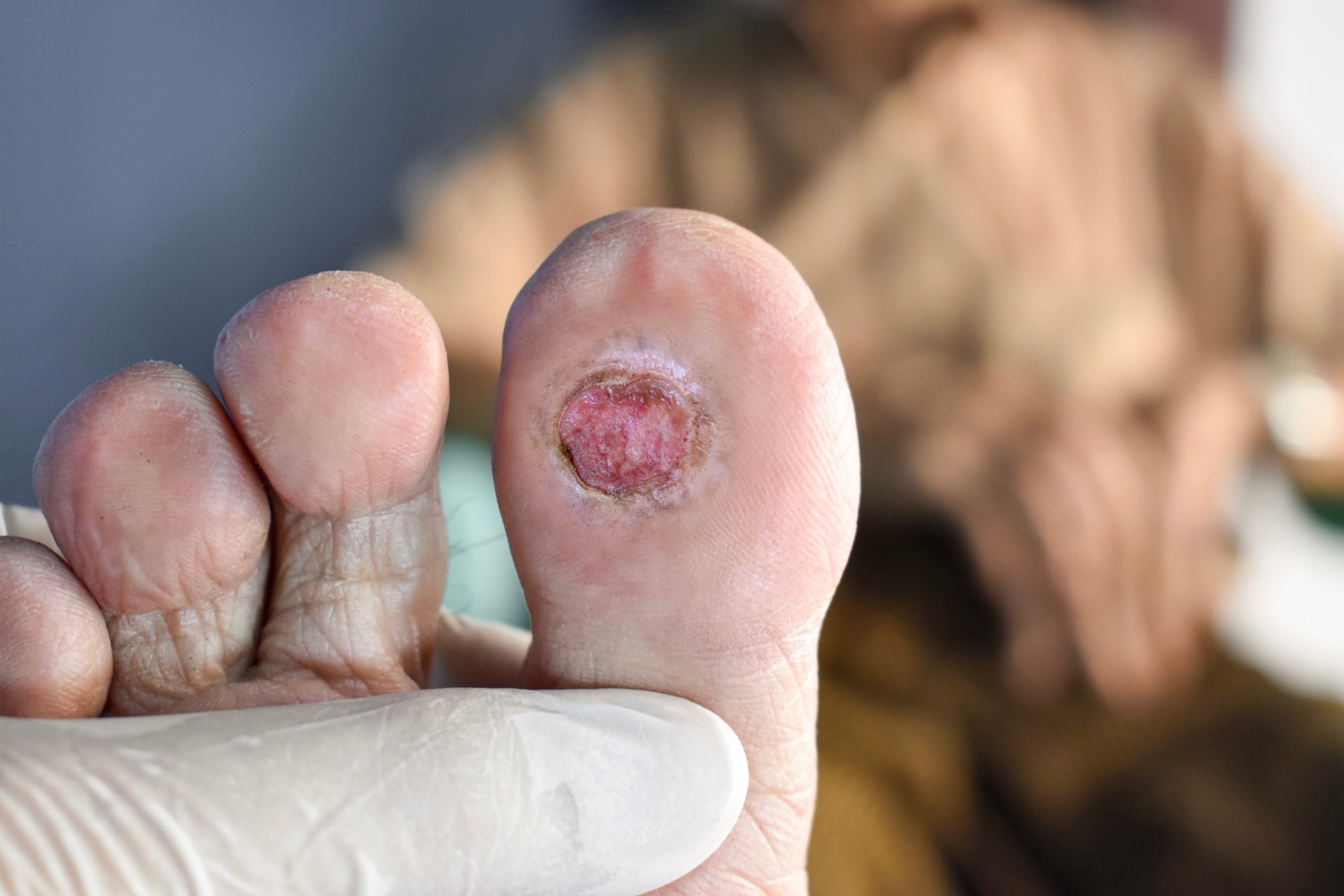 Diabetic Foot Ulcer - Toticell