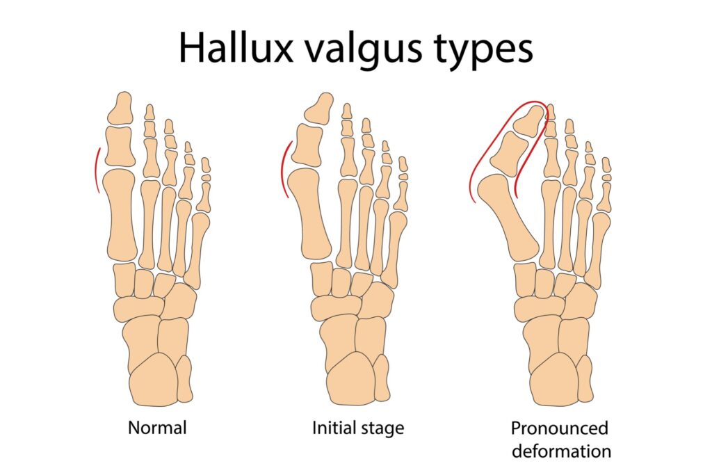 Bunion Causes, Symptoms & Bunion Correctors | Rocky Mountain Foot & Ankle