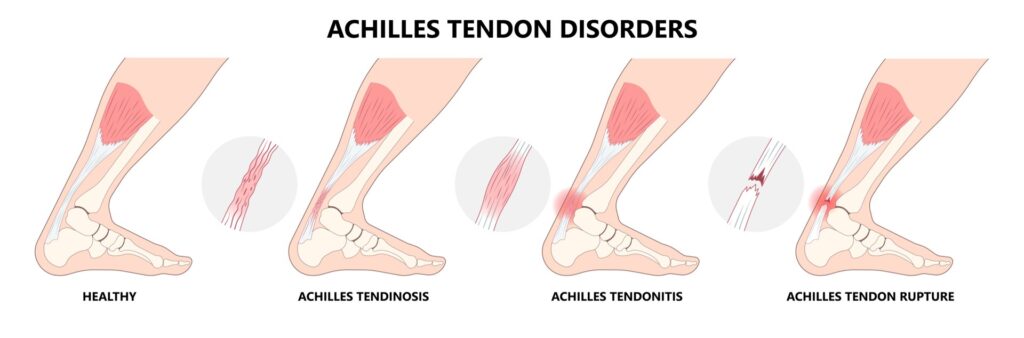 Achilles tendon rupture: management and rehabilitation | CUH