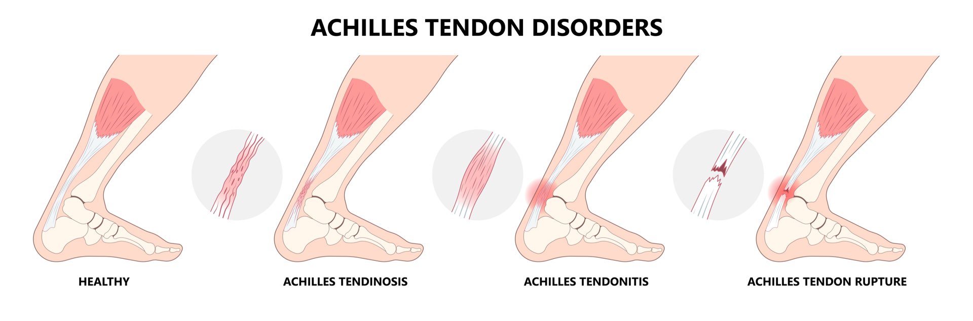 Do you have an Achilles tendon injury? Rocky Mountain Foot & Ankle
