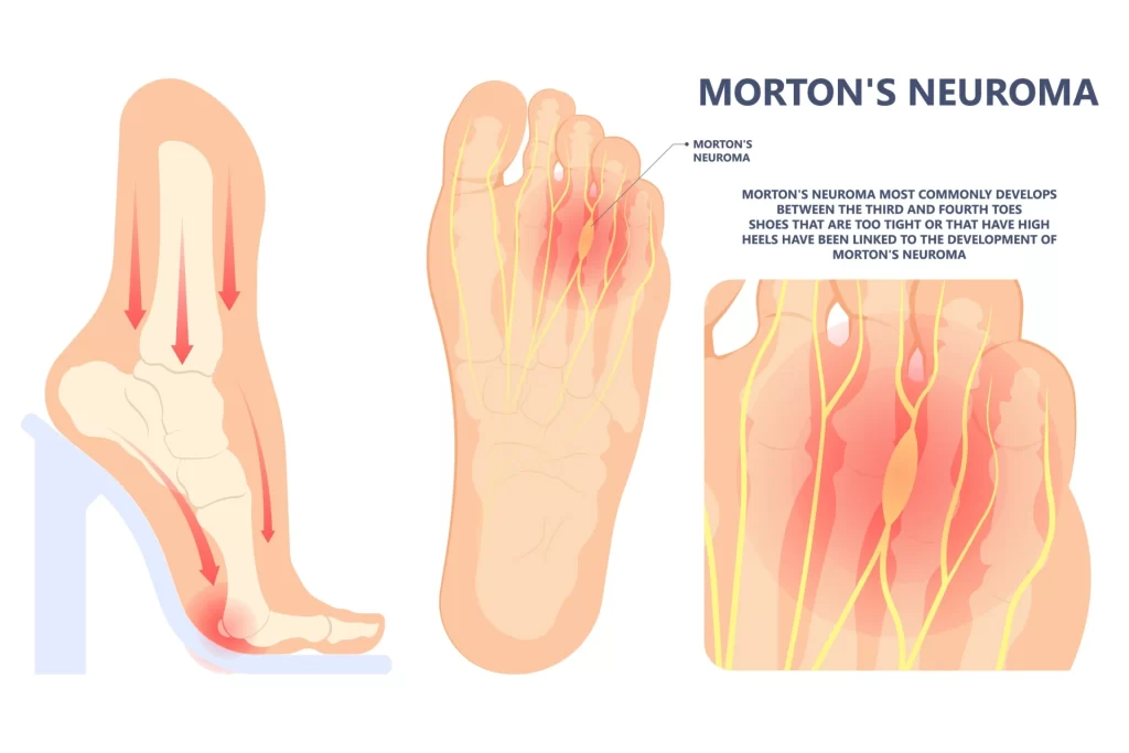 Morton's neuroma graphic