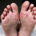 Peeling skin on feet caused by athete's foot