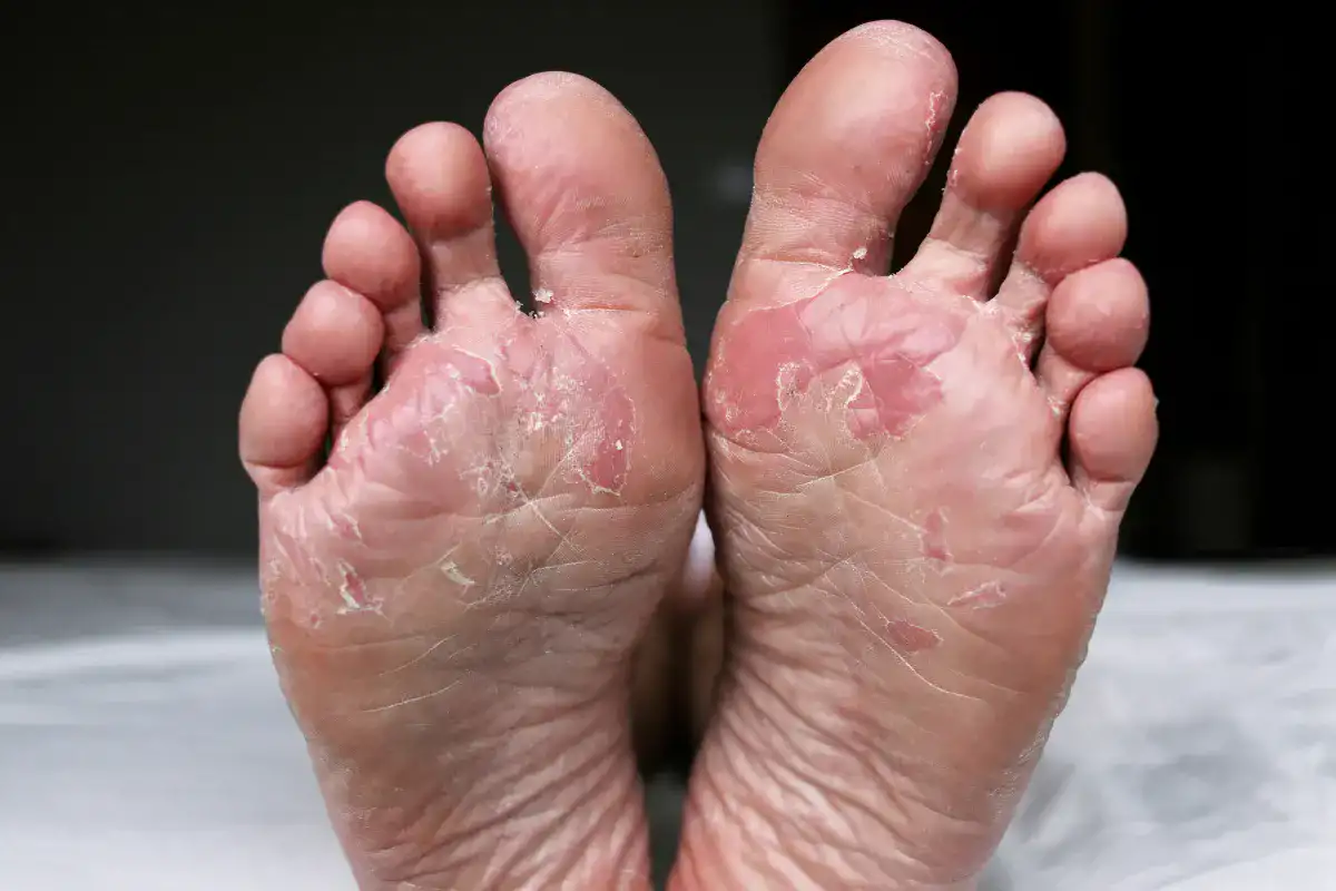 Athlete's Foot (Tinea pedis): Symptoms, Causes & Treatment - Foot Fungus 