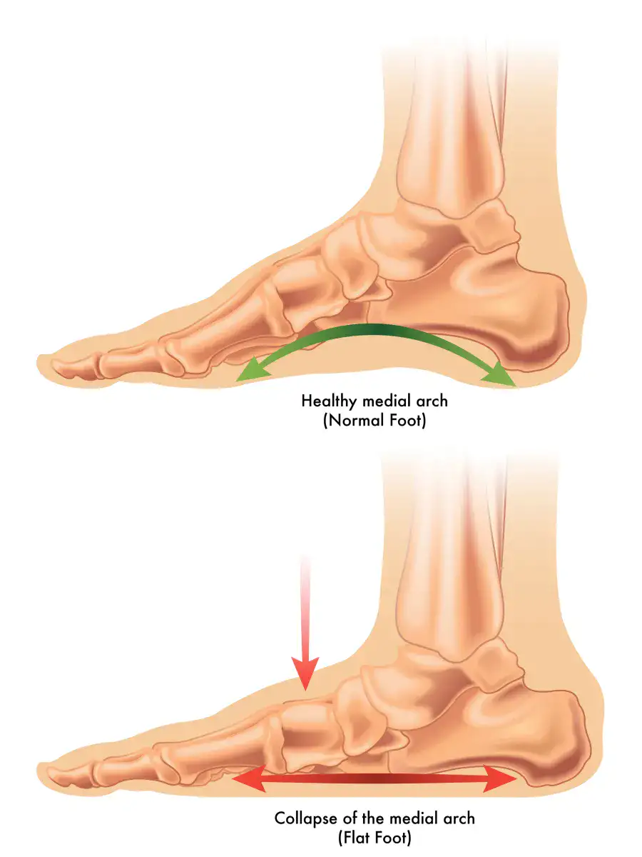 Drawing showing a regular foot arch and a flat foot