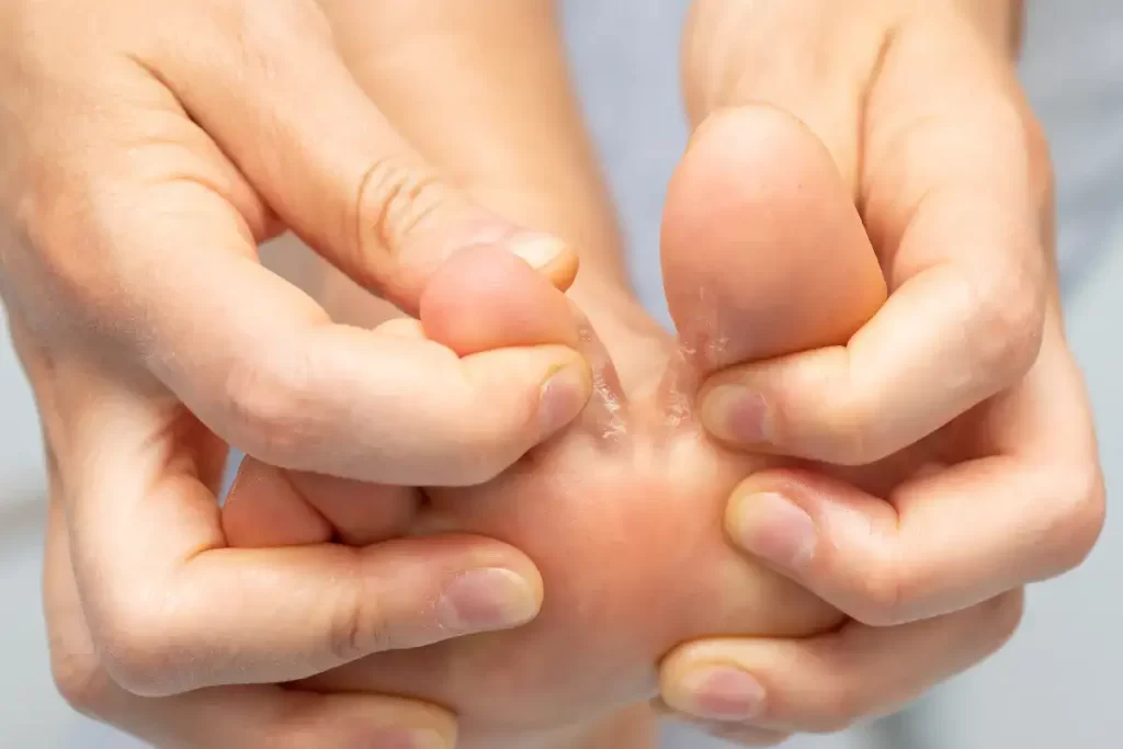 Hands pulling big toe and first toe apart to show foot fungus