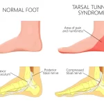 Four drawings showing a normal foot and tarsal tunnel syndrome