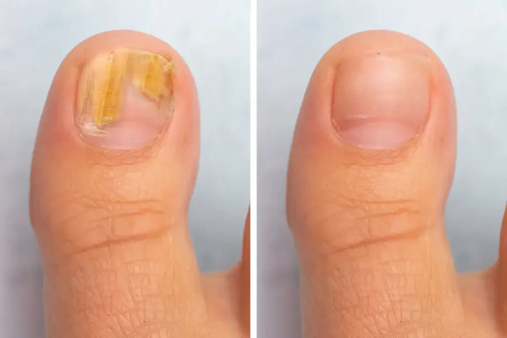 Left image shows big toenail with onychomycosis; right is after treatment