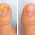 Left image shows big toenail with onychomycosis; right is after treatment