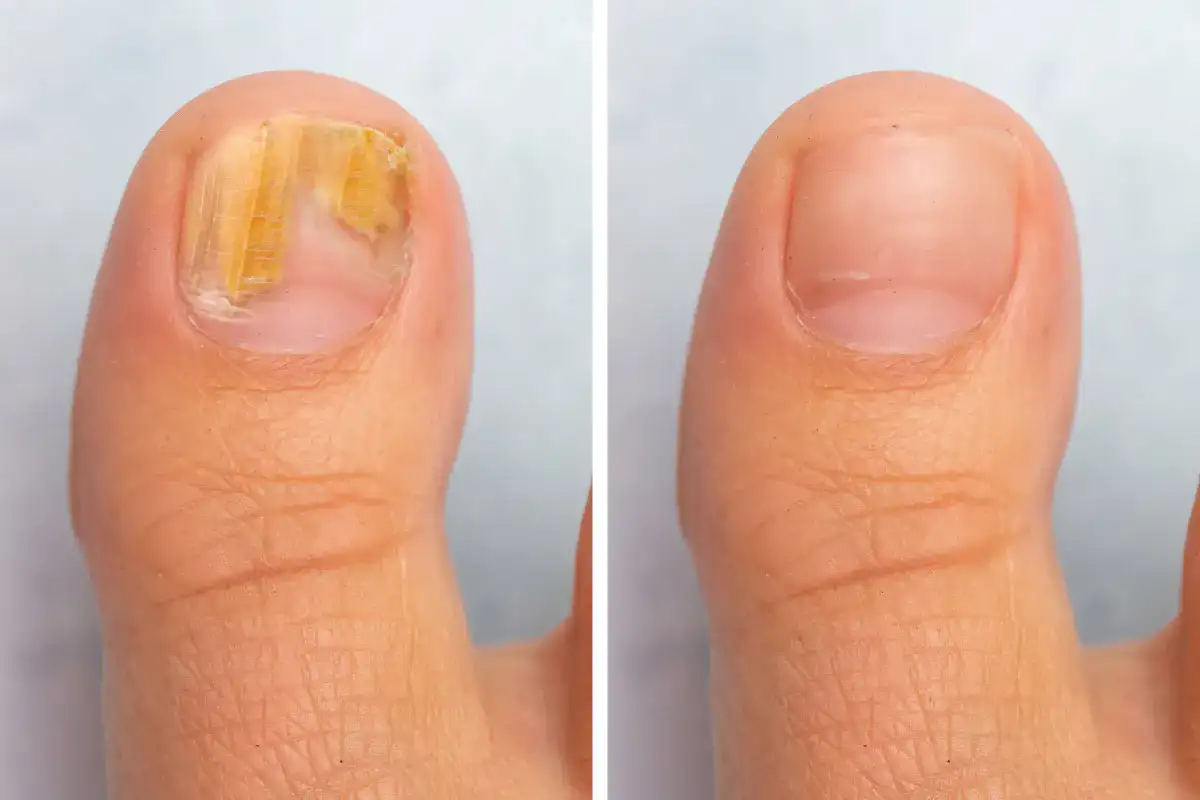 Laser Treatment for Toenail Fungus | Orange County Foot and Ankle Doctor