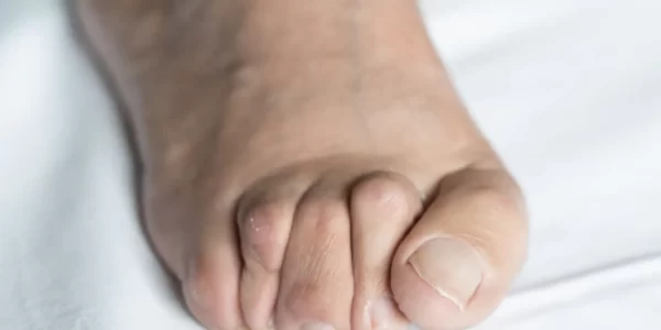 Right foot with obvious hammertoe deformity on a white sheet
