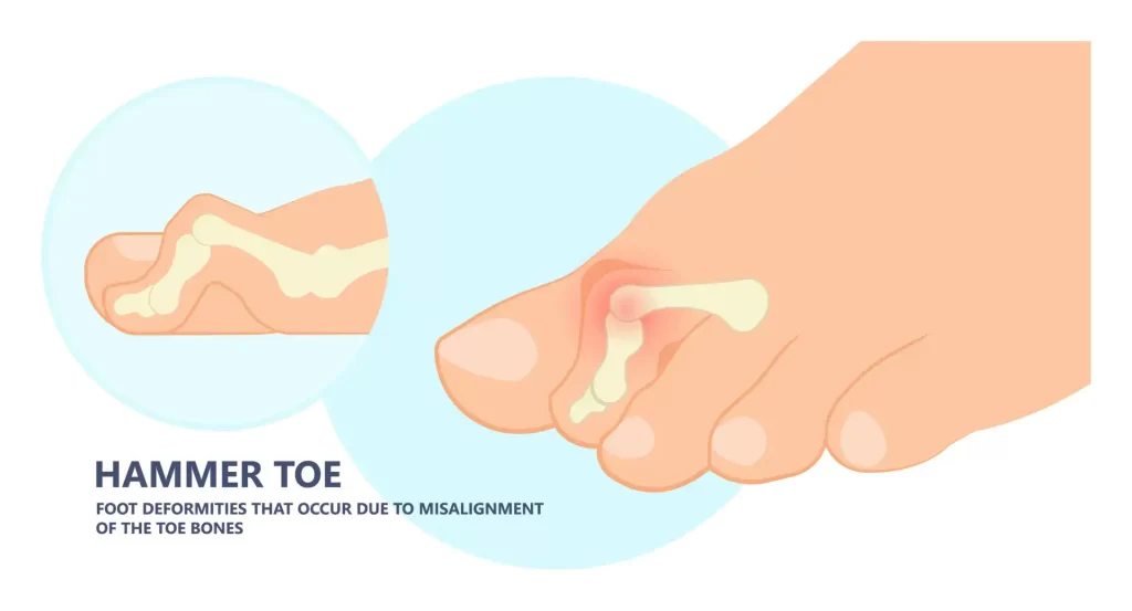Diagram showing a foot with hammertoe