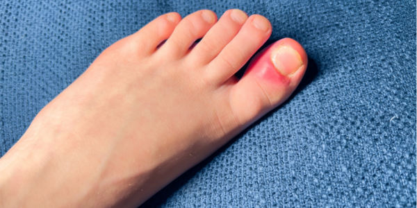 how to know if ingrown toenail is infected