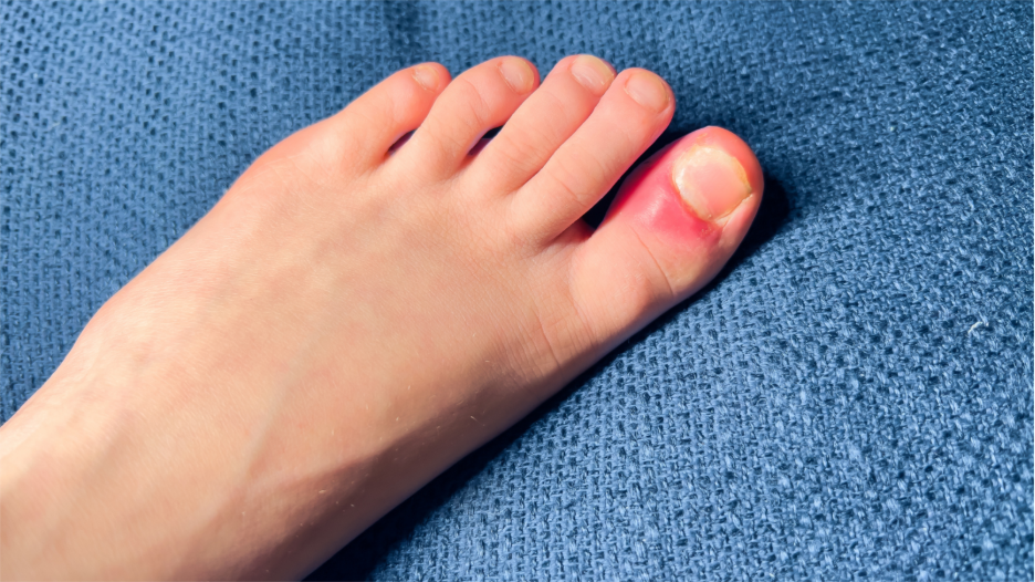how to tell if ingrown toenail is infected