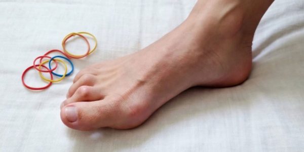 Close-up of a foot showing a hammertoe, illustrating hammertoe exercises ideas