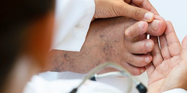 Close-up of a doctor examining a foot where the second toe crosses the big toe, illustrating issues with toes crossed