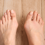 Close-up of a foot showing a bunion at the base of the big toe