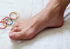 Close-up of a foot showing a hammertoe, illustrating hammertoe exercises ideas