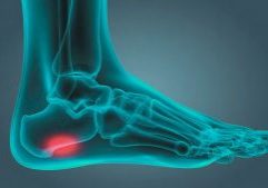 X-ray style illustration highlighting heel inflammation, showing symptoms of a ruptured plantar fascia