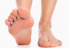 Close-up of peeling skin on feet, illustrating feet flaky skin and dry skin on feet.