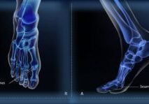 Foot x-ray showing sesamoiditis