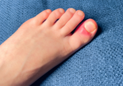 how to know if ingrown toenail is infected